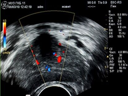 L'ecografia ha mostrato focolai di infiammazione nella prostata