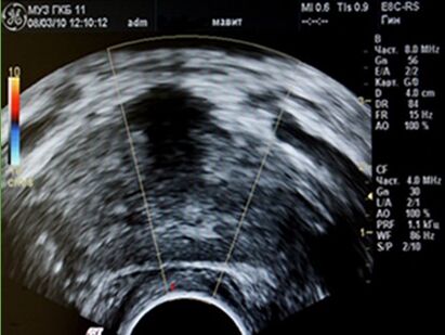 Prostovit ha alleviato l'infiammazione e ripristinato il flusso sanguigno