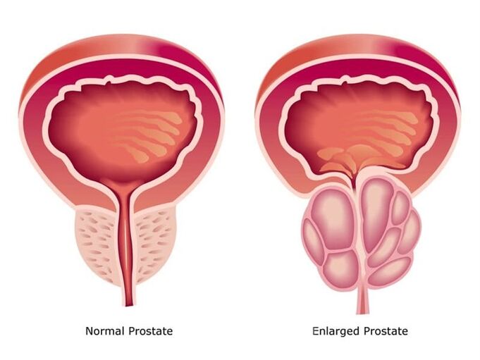 Prostovit normalizza il lavoro e le dimensioni della prostata