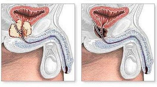 Prima e dopo il trattamento della prostatite cronica chirurgicamente