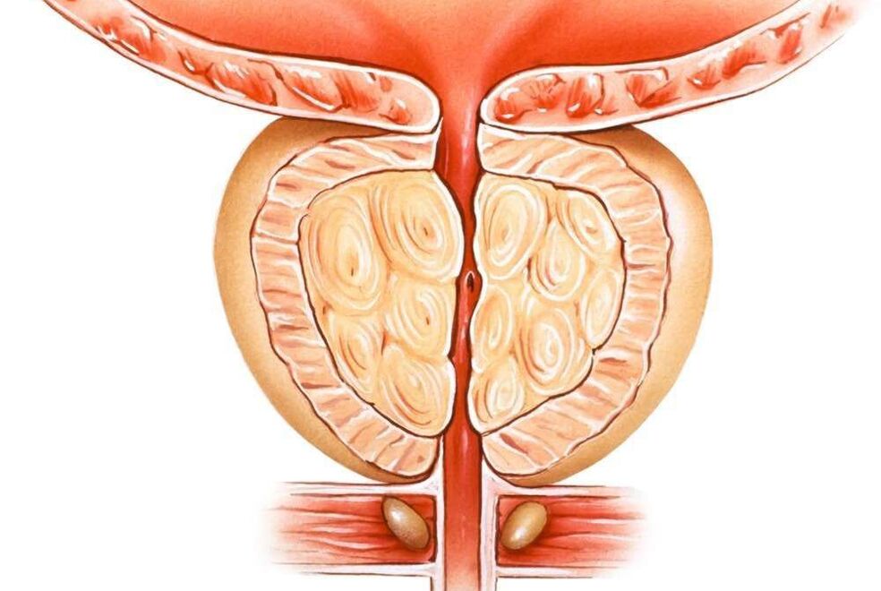 prostatite congestizia