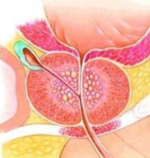 Adenoma prostatico