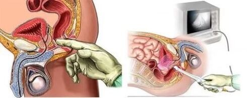 Diagnosi strumentale di prostatite